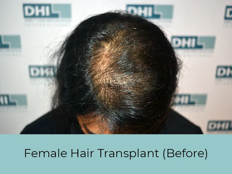 Female Hair Transplant Before
