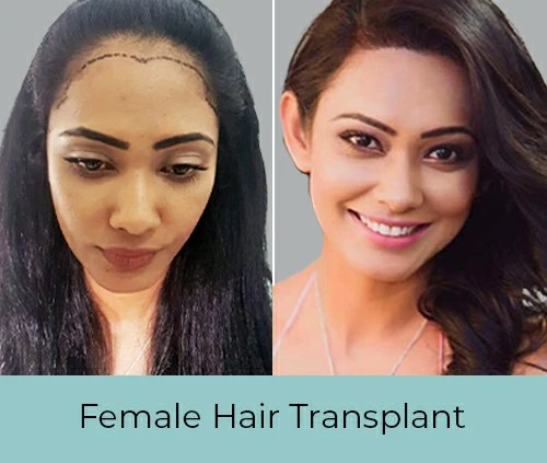 Female Hair transplant