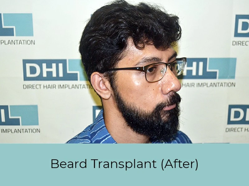 Beard Transplant After
