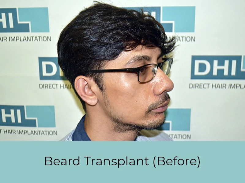 Beard Transplant Before