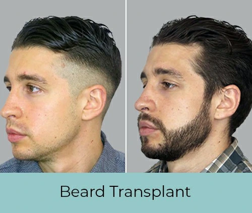 Beard Transplant