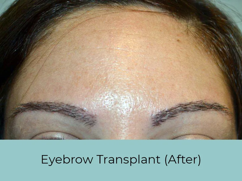 Eyebrow Transplant After