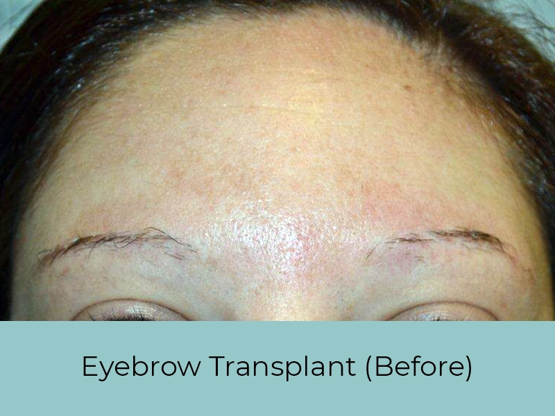 Eyebrow Transplant Before