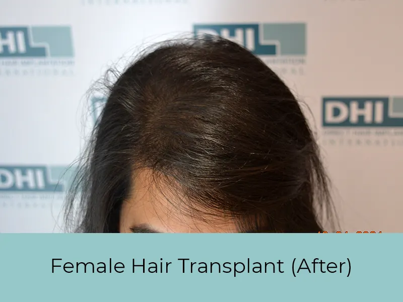 Female Hair Transplant After
