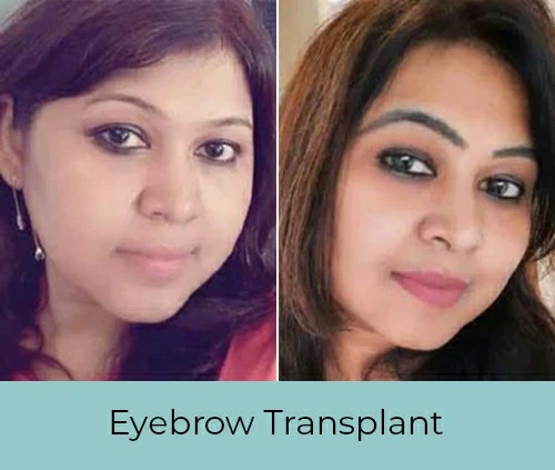 Eyebrow Transplant