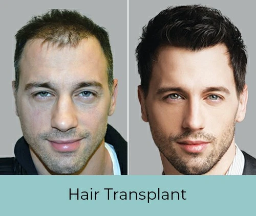 Hair Transplant