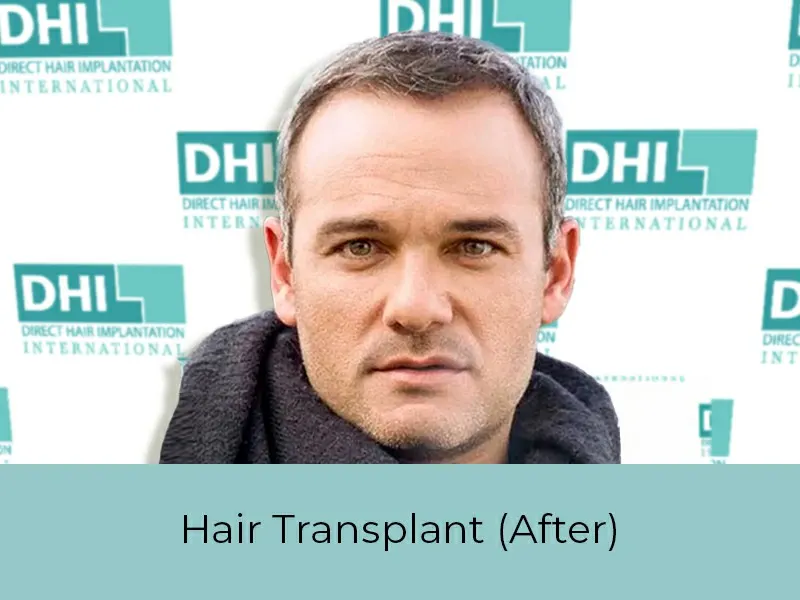 Hair Transplant After