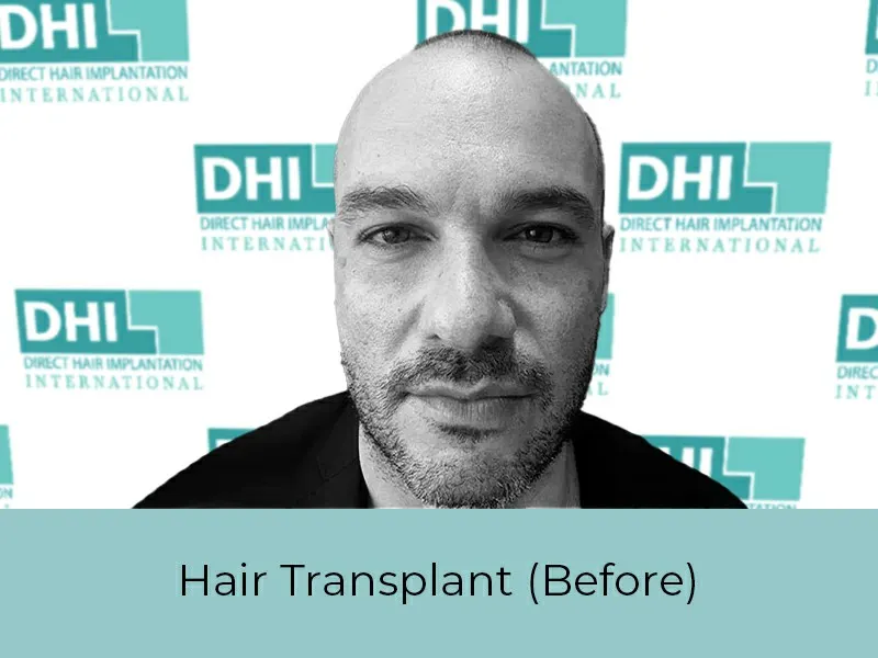 Hair Transplant Before